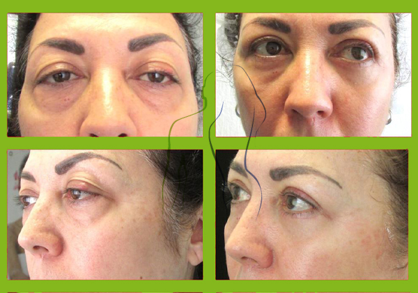 facial1