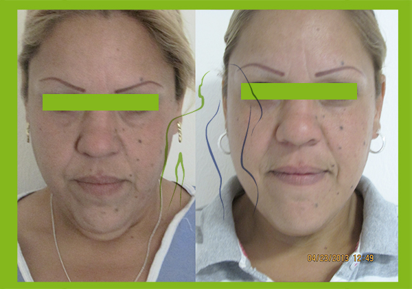 facial4